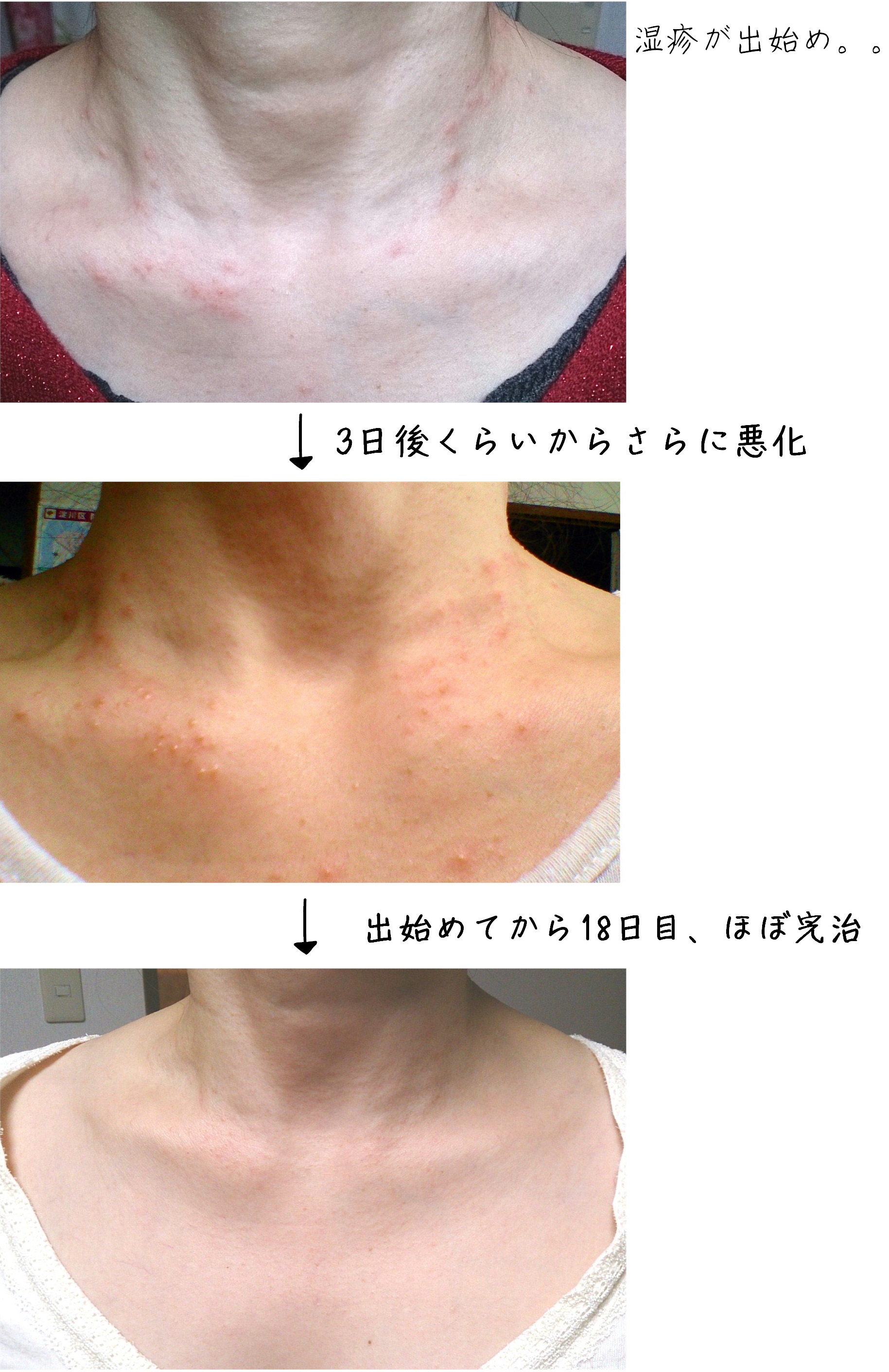 ナンナミストとオゾナジェルクリームで、金属アレルギーがすっきり